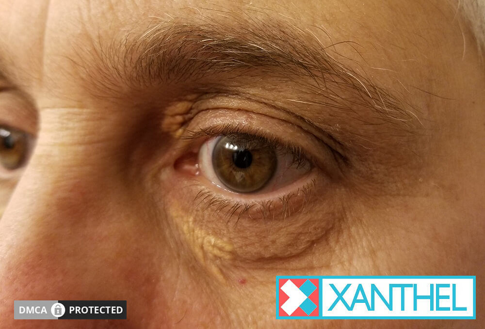 The Bottom Line on Gastric Xanthoma