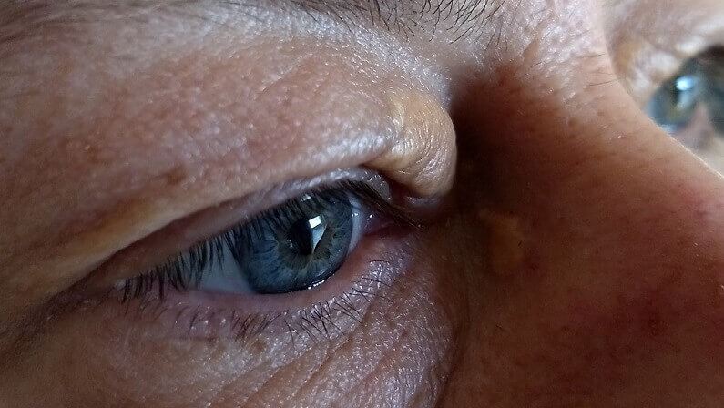 If You Were Looking for the Eyelid Type