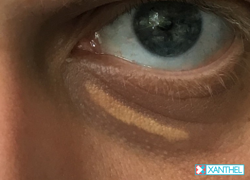 xanthelasma 4